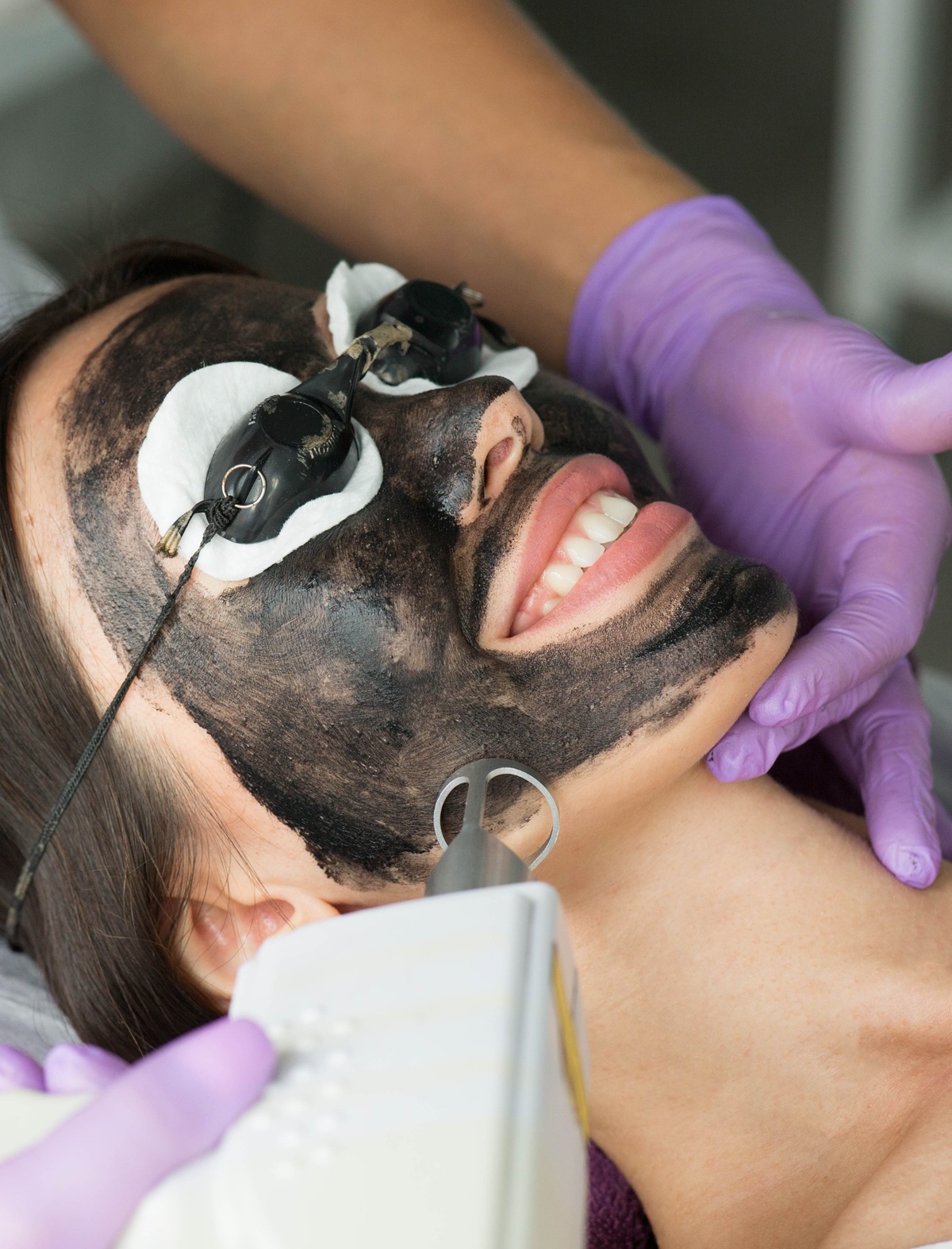 Tratamiento peeling de carbón